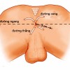 Bệnh rò hậu môn là gì?