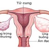 Dấu hiệu ung thư buồng trứng ở chị em