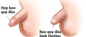 hẹp bao quy đầu ở người lớn